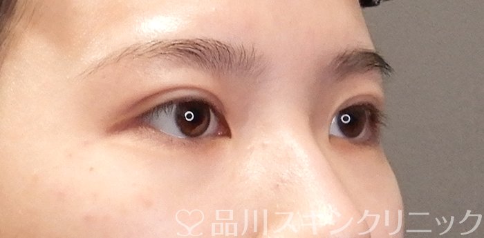 症例NO.65026のAFTER写真