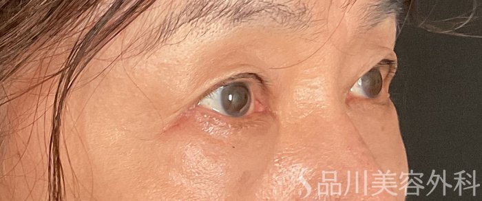 症例NO.75376のAFTER写真