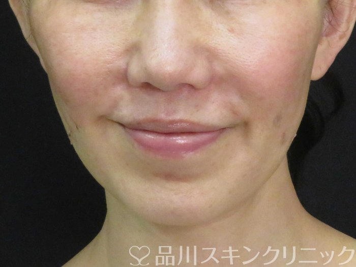 症例NO.62404のAFTER写真