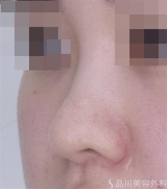 症例NO.49319のBEFORE写真