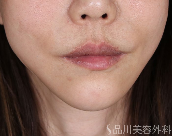 症例NO.73649のAFTER写真