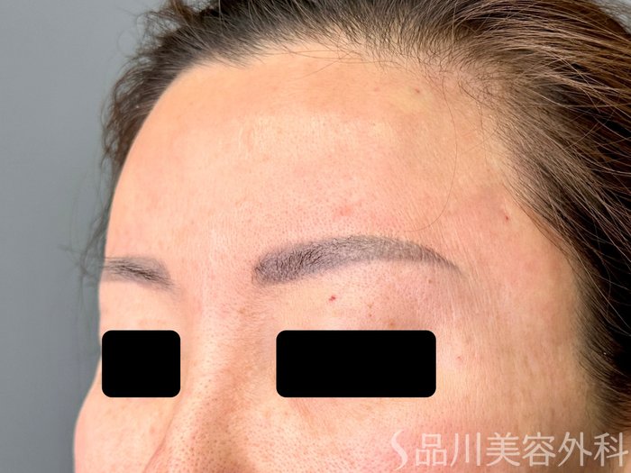 症例NO.75036のAFTER写真