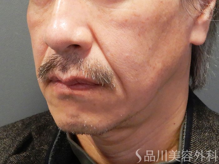 症例NO.70137のBEFORE写真