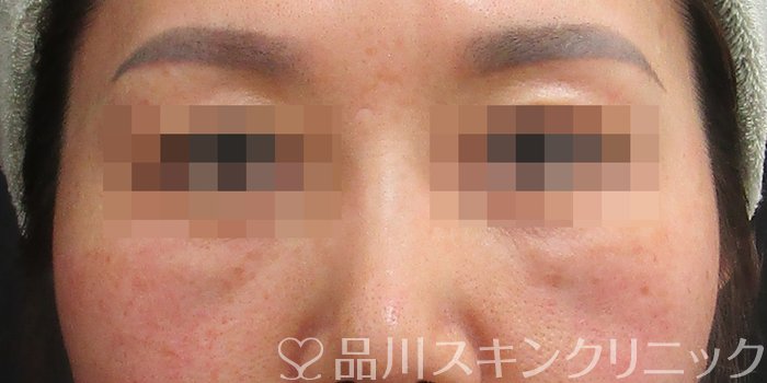 症例NO.72992のBEFORE写真