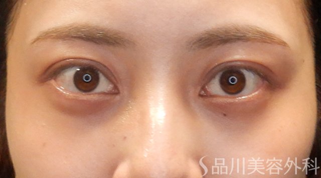 症例NO.74746のAFTER写真