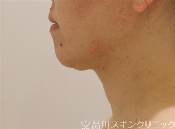 症例NO.47509のAFTER写真