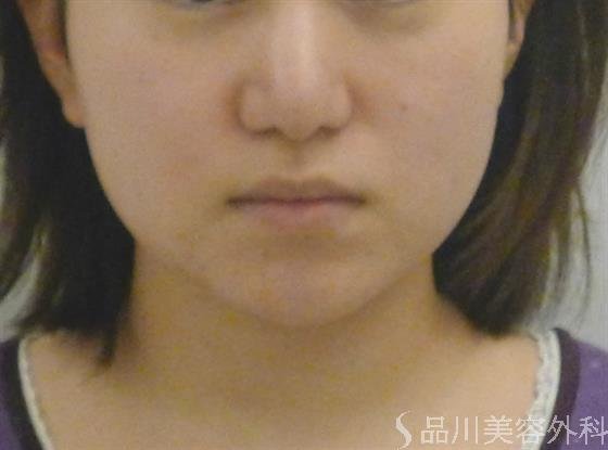 症例NO.41249のAFTER写真