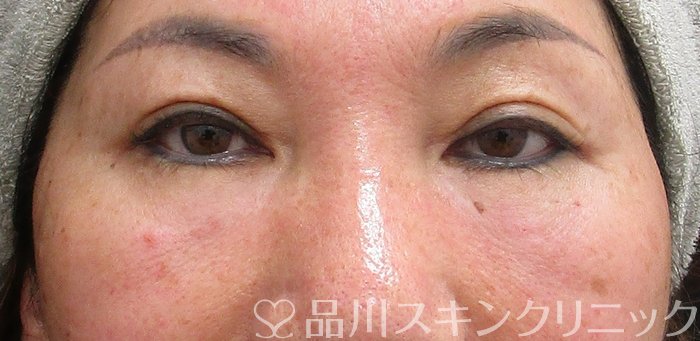 症例NO.69853のAFTER写真