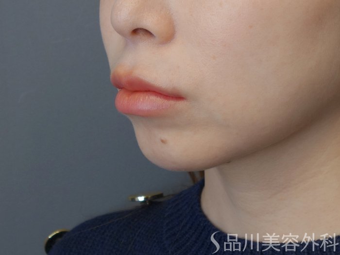 症例NO.72584のBEFORE写真