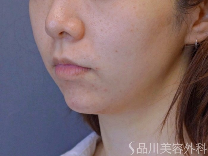 症例NO.74004のAFTER写真