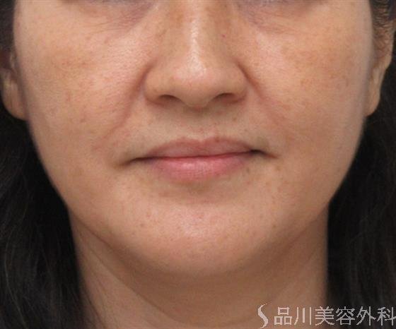 症例NO.29955のBEFORE写真
