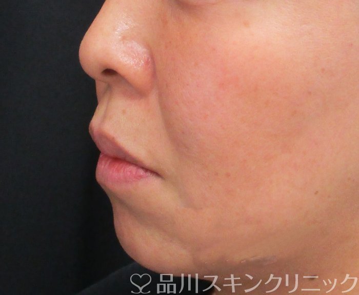 症例NO.73248のAFTER写真