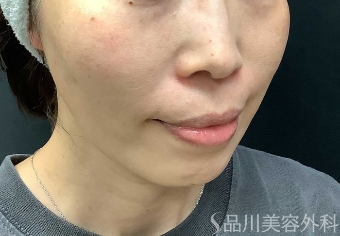 症例NO.71036のAFTER写真