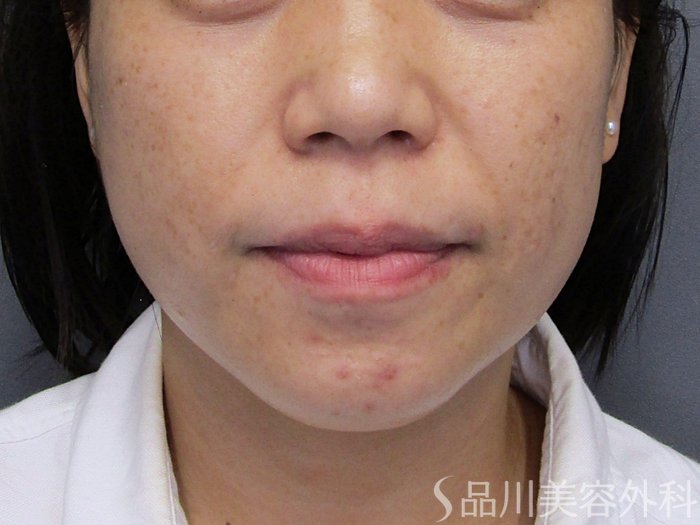 症例NO.74824のBEFORE写真