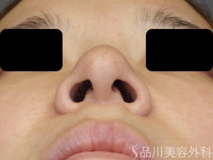 症例NO.71591のBEFORE写真