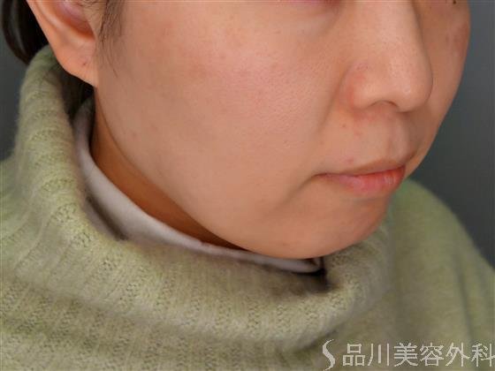 症例NO.55049のBEFORE写真