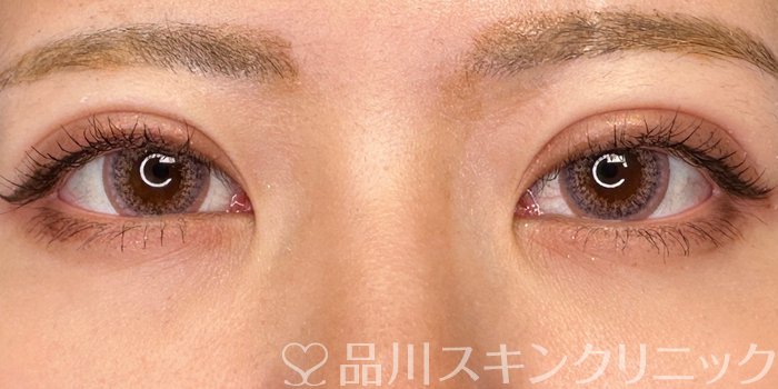 症例NO.65513のAFTER写真