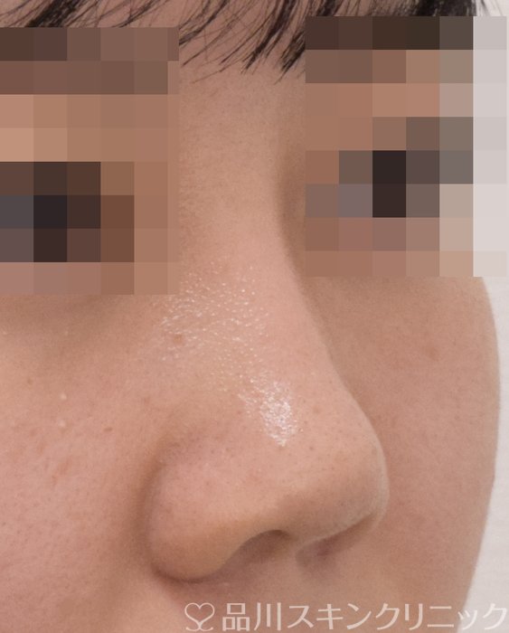 症例NO.71736のAFTER写真