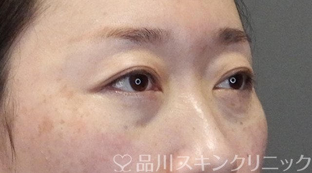 症例NO.64501のAFTER写真