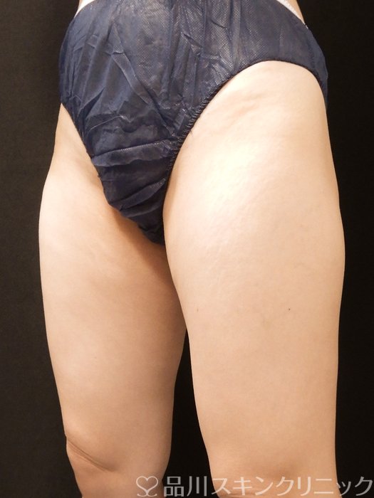 症例NO.68087のAFTER写真