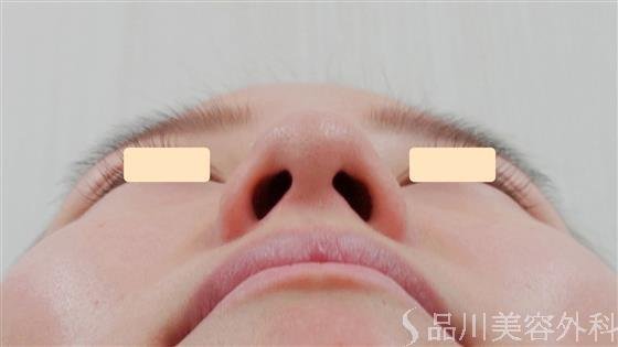 症例NO.30780のBEFORE写真
