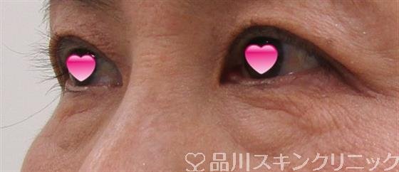 症例NO.41446のBEFORE写真