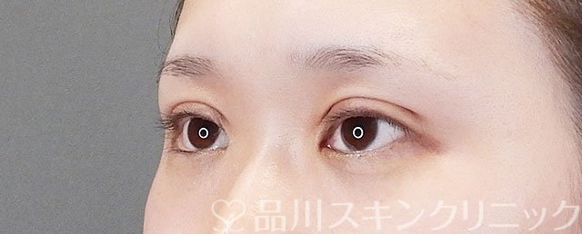 症例NO.75272のAFTER写真