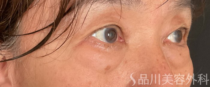 症例NO.75151のBEFORE写真