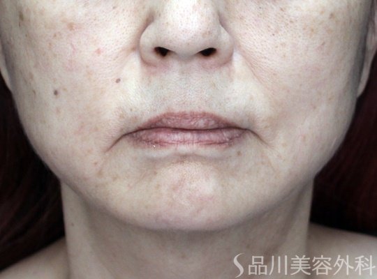 症例NO.70347のAFTER写真