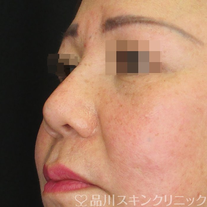 症例NO.73184のAFTER写真