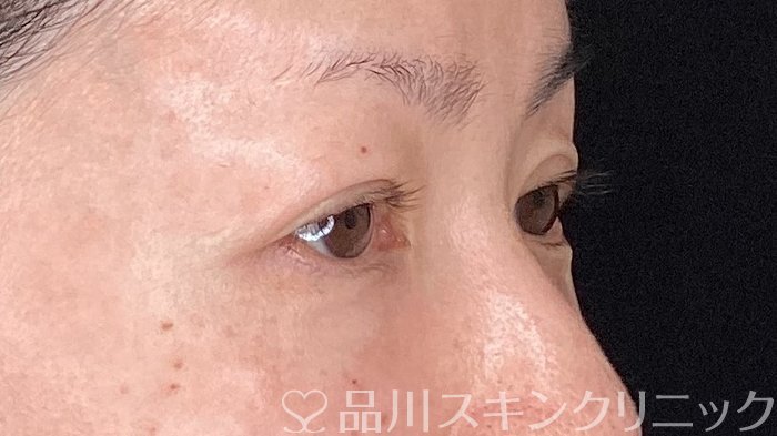 症例NO.64479のAFTER写真