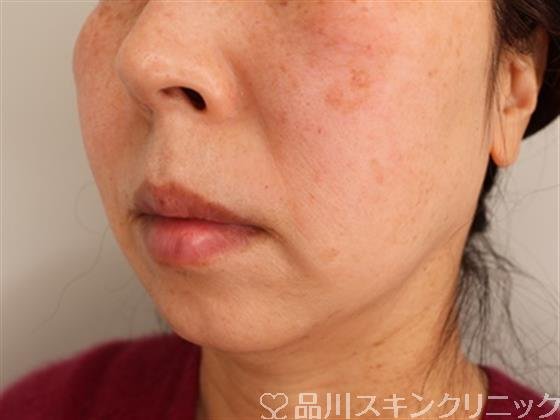 症例NO.50290のAFTER写真