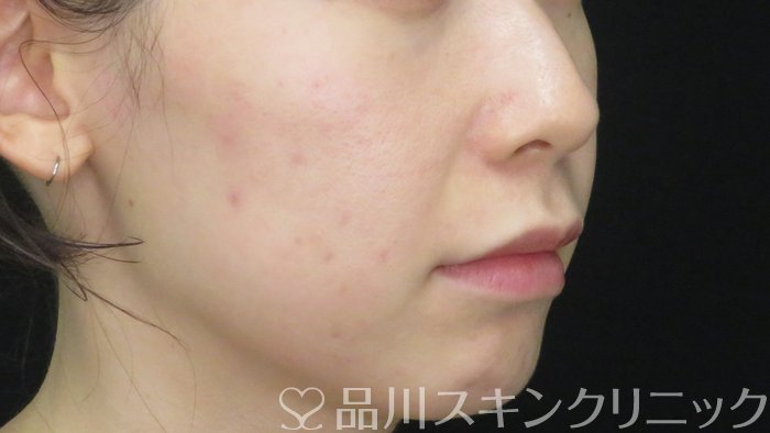症例NO.71576のAFTER写真