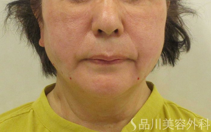 症例NO.70798のAFTER写真