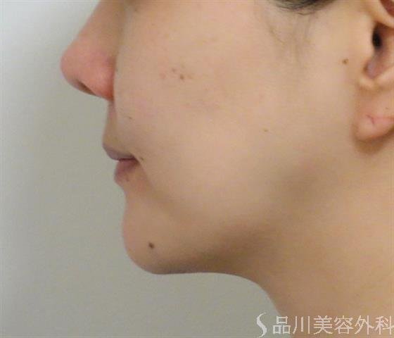 症例NO.40839のBEFORE写真