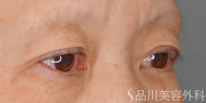 症例NO.69911のBEFORE写真