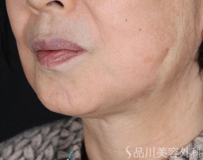 症例NO.72290のAFTER写真