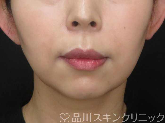 症例NO.69827のBEFORE写真