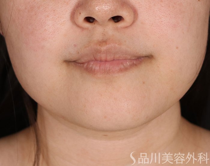 症例NO.72977のBEFORE写真