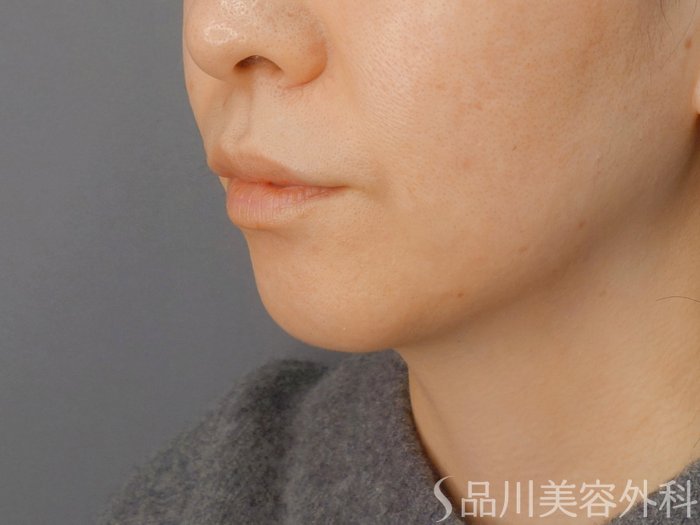 症例NO.72611のBEFORE写真