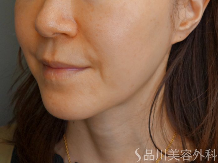 症例NO.70209のBEFORE写真
