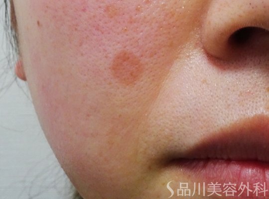 症例NO.74379のBEFORE写真
