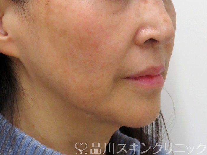 症例NO.73763のAFTER写真