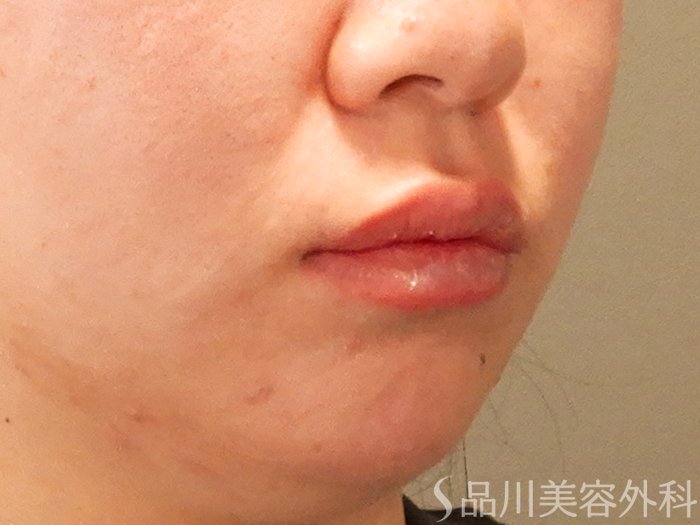 症例NO.70127のAFTER写真
