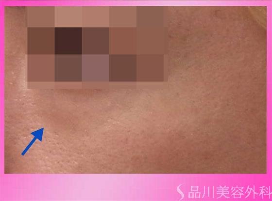 症例NO.31743のBEFORE写真