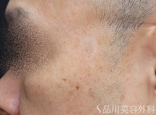 症例NO.67758のAFTER写真