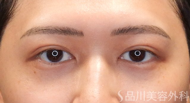 症例NO.74985のAFTER写真