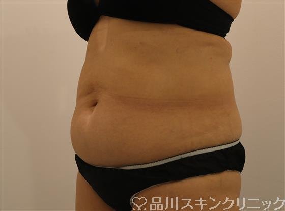 症例NO.43910のBEFORE写真