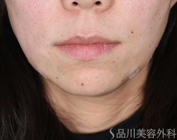 症例NO.72811のAFTER写真