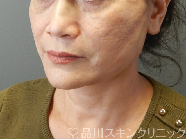 症例NO.65712のAFTER写真